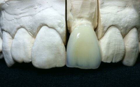 korona na ząb 21 z kompozytu SHOFU Ceramage, modyfikacje przezierności