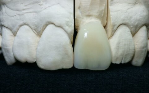 korona na ząb 21 z kompozytu SHOFU Ceramage, naturalny wygląd brzegu siecznego
