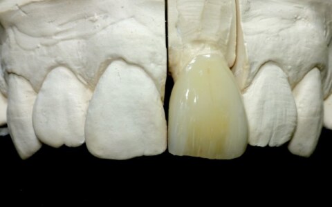 korona na ząb 21 z kompozytu SHOFU Ceramage, ząb starszego pacjenta