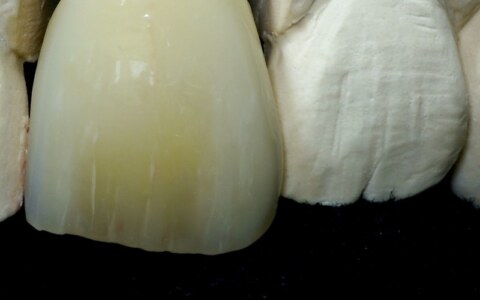 korona na ząb 21 z kompozytu SHOFU Ceramage, ząb starszego pacjenta, szczegóły charakteryzacji